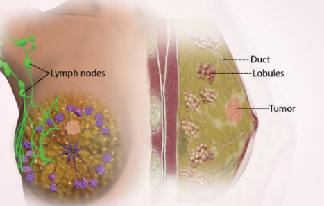 Hình ảnh ung thư vú. Lymph nods: các hạch lympho; Duct: ống dẫn sữa; Lobules: thùy tuyến sữa; Tumor