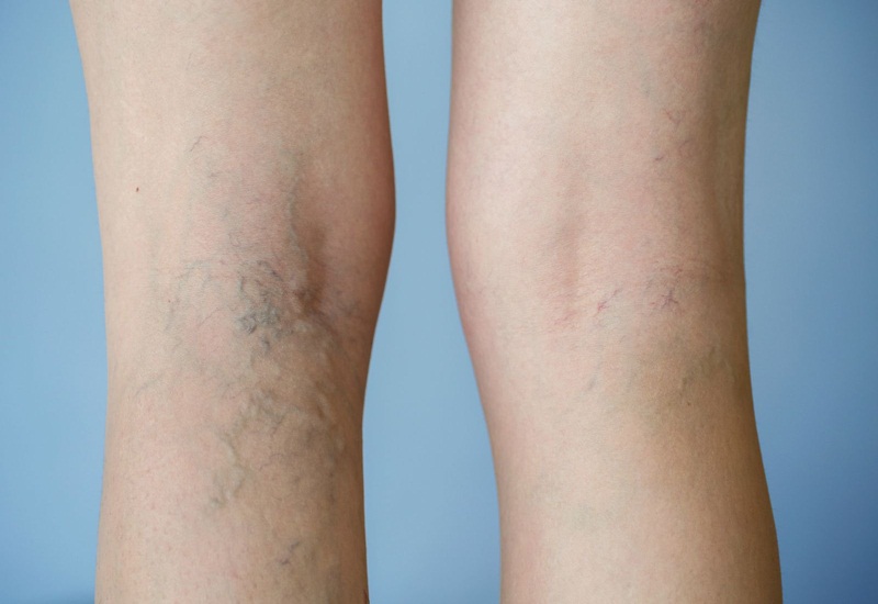 Giãn tĩnh mạch chân dễ chuyển biến thành bệnh mạn tính