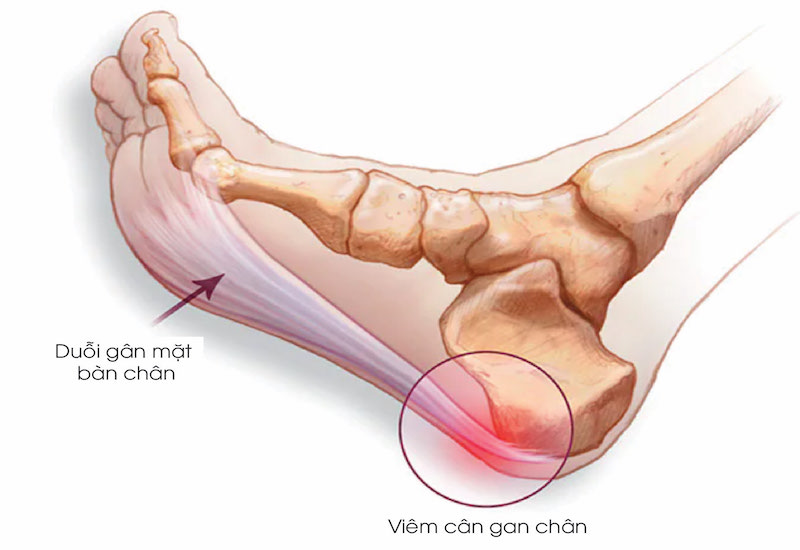 Viêm cân gan chân là một trong những nguyên nhân dẫn đến bệnh gai gót chân