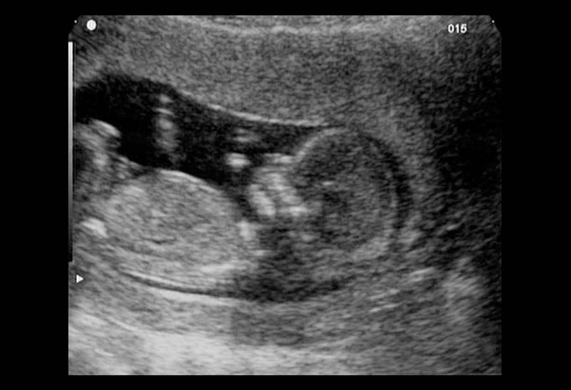 Hình ảnh thai nhi khi siêu âm 
