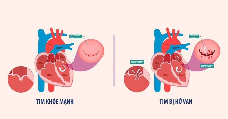   Van tim bị hở sẽ gây ra tình trạng máy chảy ngược trở lại khoang trước đó 