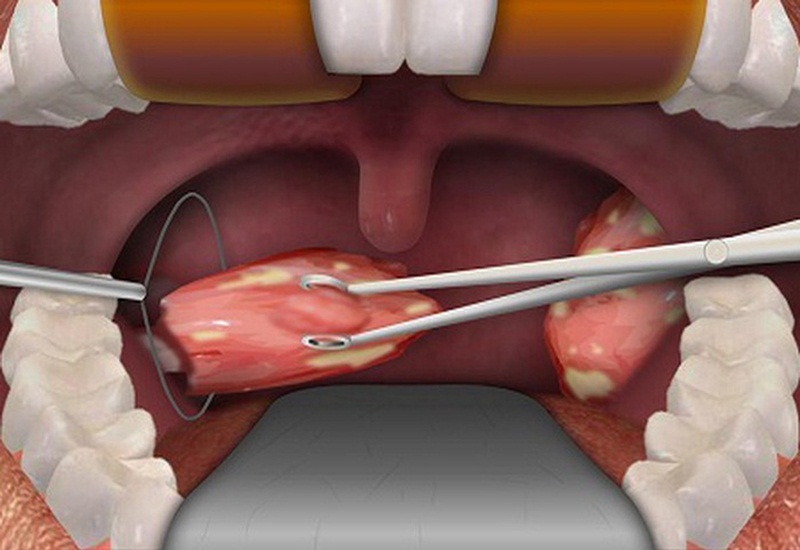 Phẫu thuật cắt bỏ amidan thường diễn ra trong một thời gian ngắn