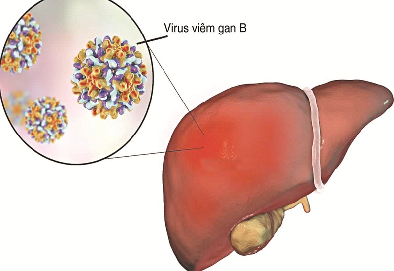 Nhiễm virus viêm gan B trên 6 tháng được gọi là viêm gan B mạn tính