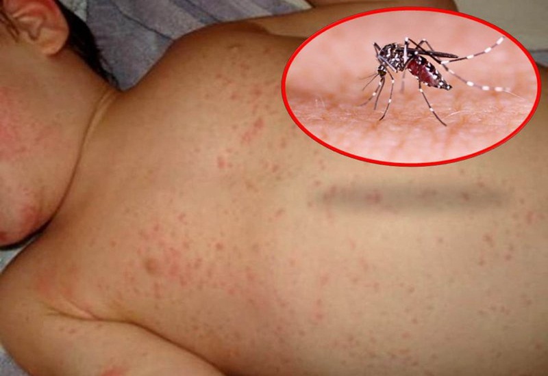 Sốt xuất huyết có thể lây truyền qua vết muỗi đốt