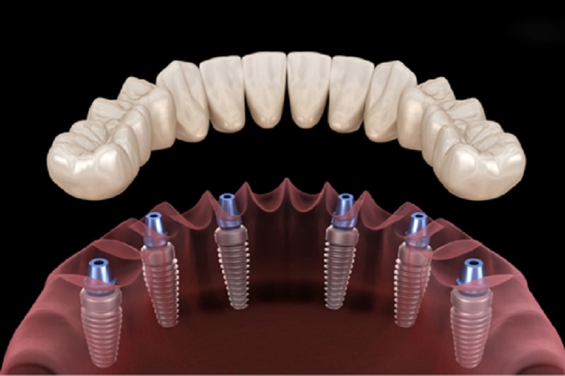 Việc khôi phục toàn bộ hàm răng với số trụ Implant ít sẽ đảm bảo sức khỏe cho người bệnh