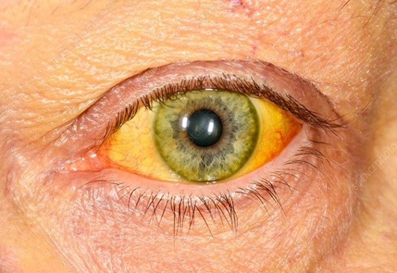 Vàng mắt, vàng da là một dấu hiệu của viêm gan A