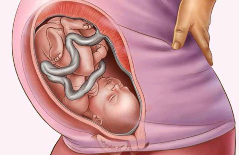 Mẹ nên làm gì khi thai nhi bị dây rốn quấn cổ 1 vòng?