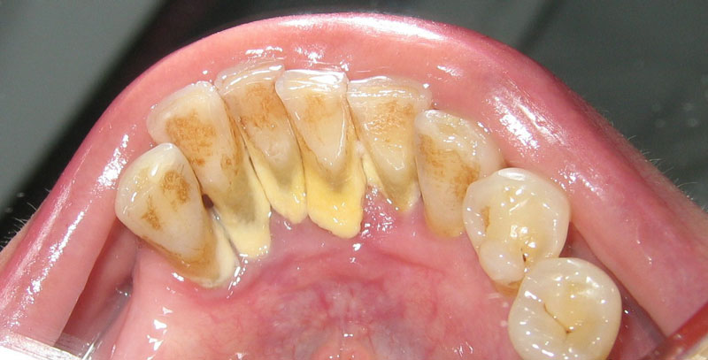 Mảng bám có gây hại cho sức khoẻ răng miệng không