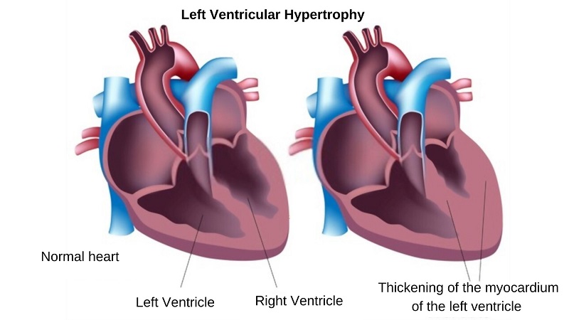Dày thất trái là tình trạng khá phổ biến hiện nay do tim hoạt động quá tải