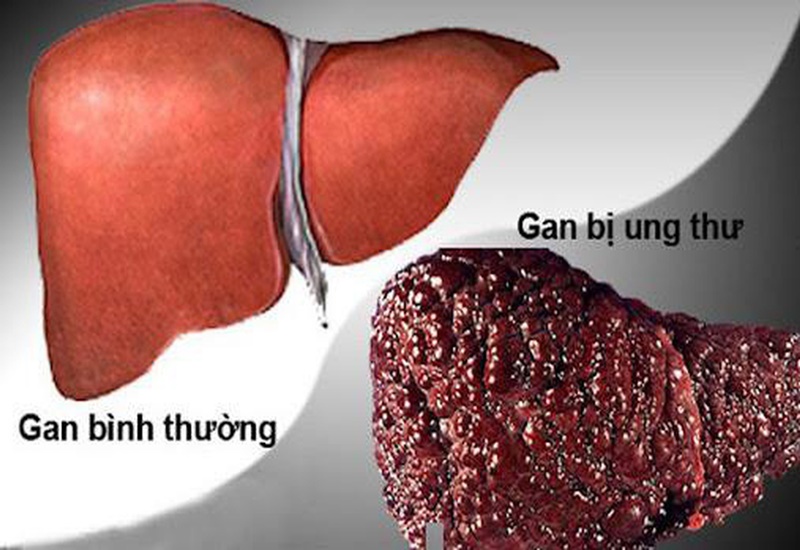 Ung thư gan rất phổ biến ở Việt Nam