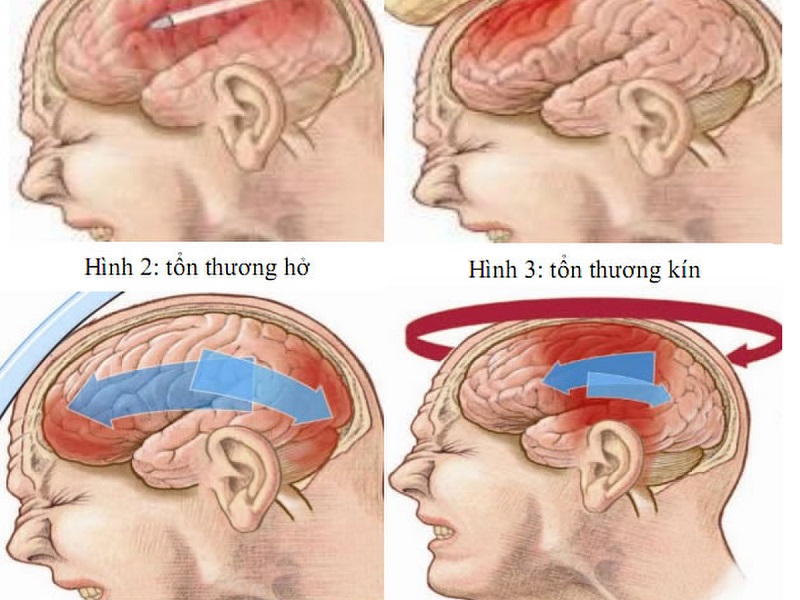 Tổn thương ở sọ não là một trong những nguyên nhân gây liệt dây thần kinh số IV