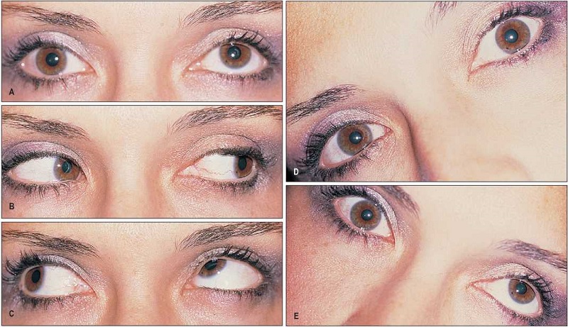 Một số biểu hiện ở mắt của người bị liệt dây thần kinh số IV