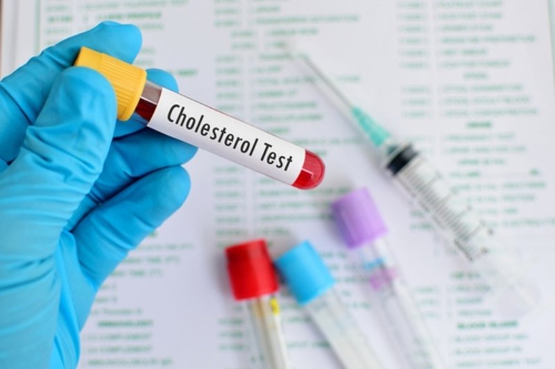Test Cholesterol yêu cầu nhịn ăn trước khi lấy mẫu xét nghiệm