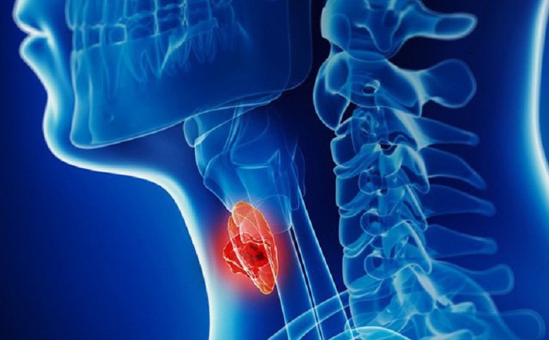 Ung thư hạ họng là bệnh lý phổ biến và thường gặp ở nam giới