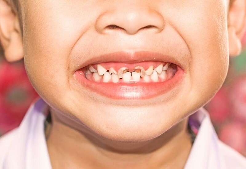 Các bác sĩ sẽ đưa ra phương pháp điều trị phù hợp tùy mức độ sâu răng
