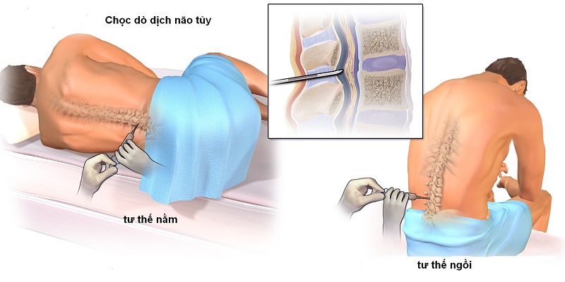 Khi thực hiện chọc hút dịch tủy xương, người bệnh có thể ngồi hoặc nằm nghiêng sang một bên