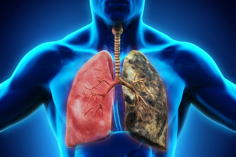 Bệnh ung thư phổi có tỷ lệ người mắc và tử vong rất cao