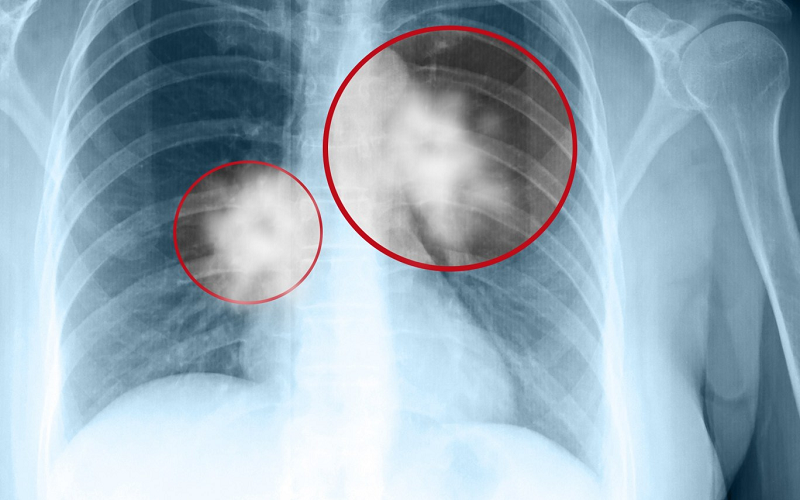 Chụp X-quang là một trong các phương pháp giúp phát hiện tổn thương phổi