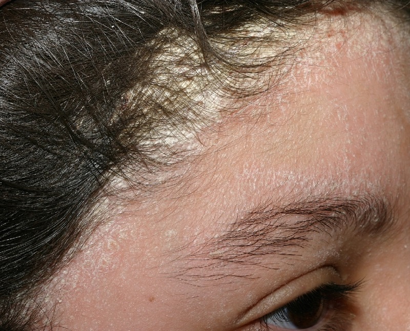 Bệnh vảy nến da đầu là một trong các nguyên nhân khiến cho đầu nhiều gầu