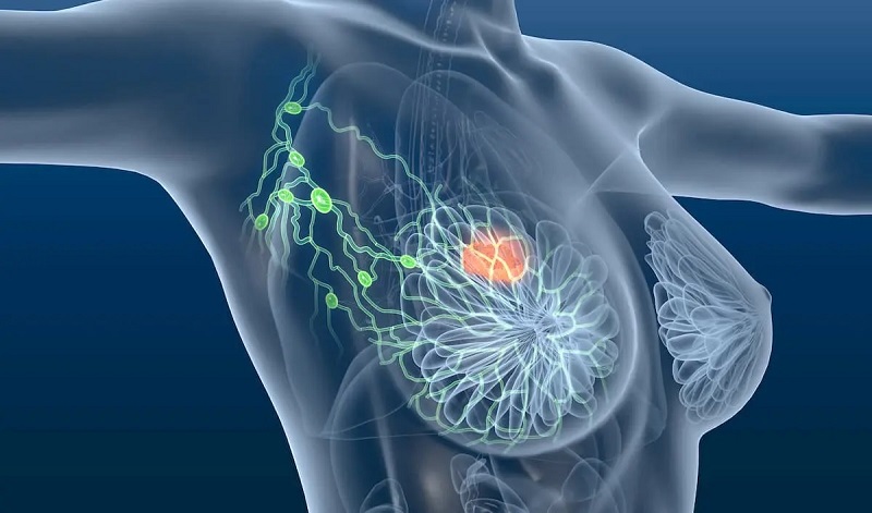 Ở giai đoạn nặng, khối u sẽ di căn đến nhiều cơ quan khác trong cơ thể