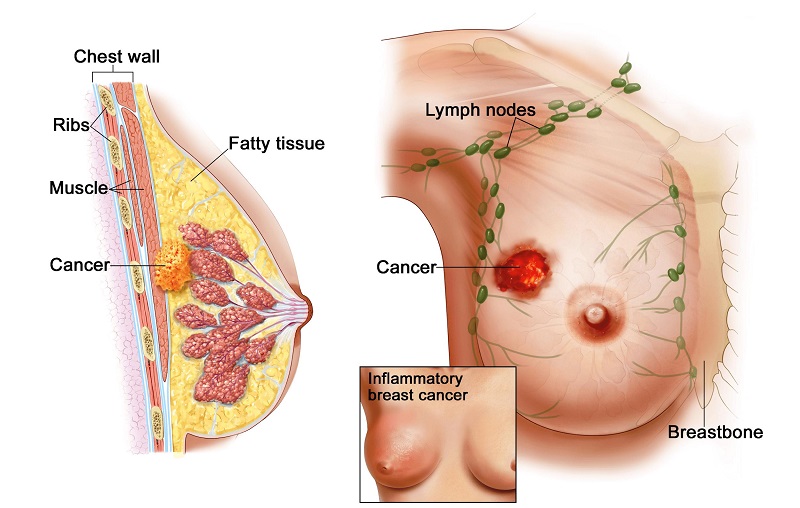 Các tế bào trong vú phát triển một cách mất kiểm soát sẽ dẫn đến ung thư