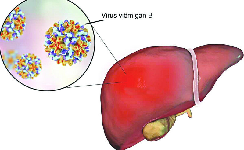 Viêm gan B là một trong các bệnh lý phổ biến hiện nay