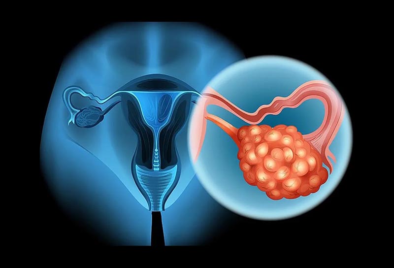 Ung thư buồng trứng di căn có thể coi là án tử thứ hai, sau ung thư tử cung