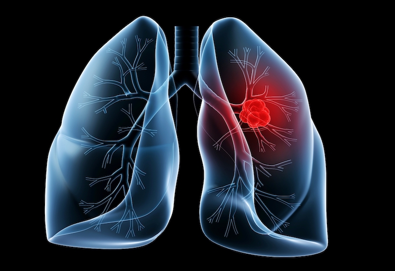 Ung thư phổi phát triển trong bao lâu là băn khoăn của rất nhiều người bệnh