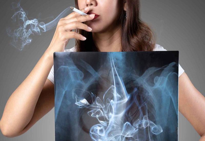 Hút thuốc làm giảm tuổi thọ của bệnh nhân ung thư phổi