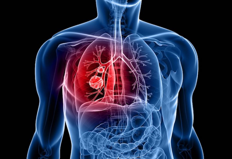 Ung thư phổi không tế bào nhỏ giai đoạn 4 xảy ra khi khối u bắt đầu có dấu hiệu di căn từ vị trí nguyên phát ban đầu