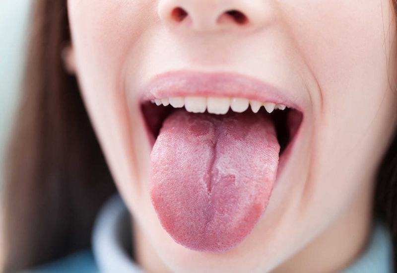 Bệnh viêm lưỡi ở người lớn có thể là do virus gây nên