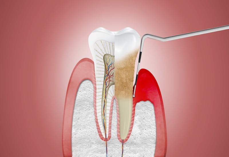 Nếu răng miệng không được chăm sóc kỹ lưỡng có thể sẽ dẫn đến viêm nha chu nặng