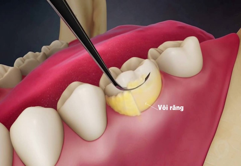 Mô phỏng tình trạng cao răng tích tụ trên bề mặt răng