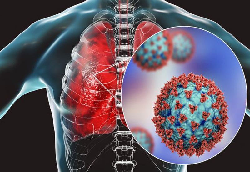 Viêm phổi cấp có thể do một số loại virus