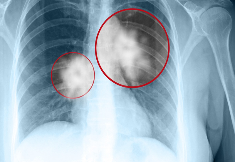 Chụp X-quang phổi để tầm soát ung thư phổi