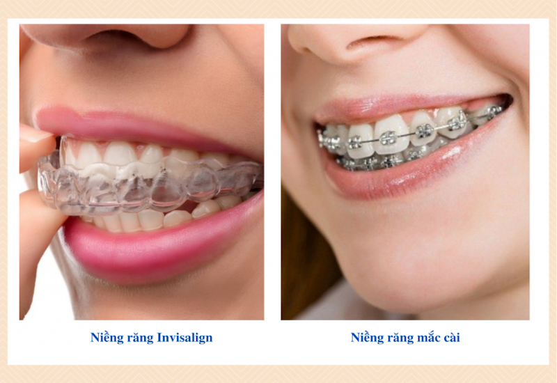 Niềng răng trong suốt Invisalign đảm bảo tính thẩm mỹ cao hơn so với niềng răng mắc cài