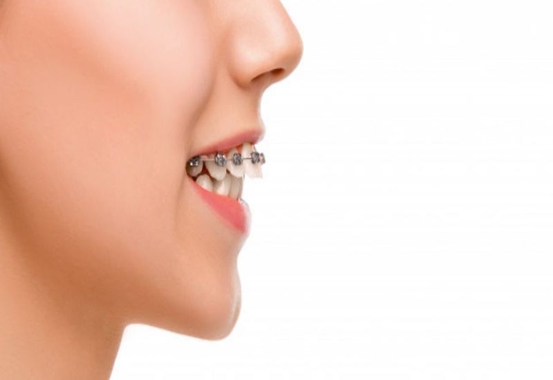 Niềng răng sẽ giúp cải thiện tình trạng lệch khớp cắn