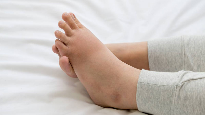 Phù nề chân thường gặp ở phụ nữ mang thai