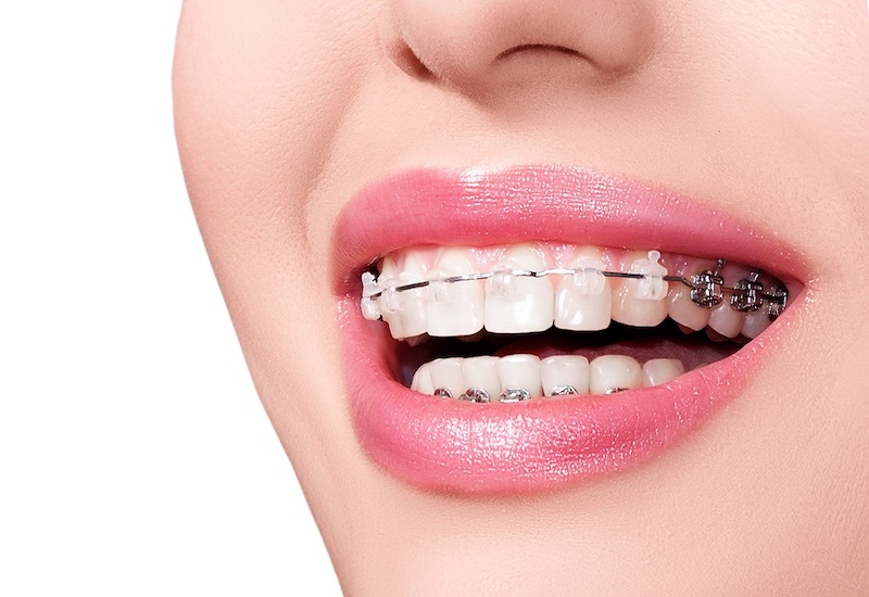Chỉnh nha cố định là phương pháp đảm bảo hiệu quả nhất trong số các loại hình niềng răng