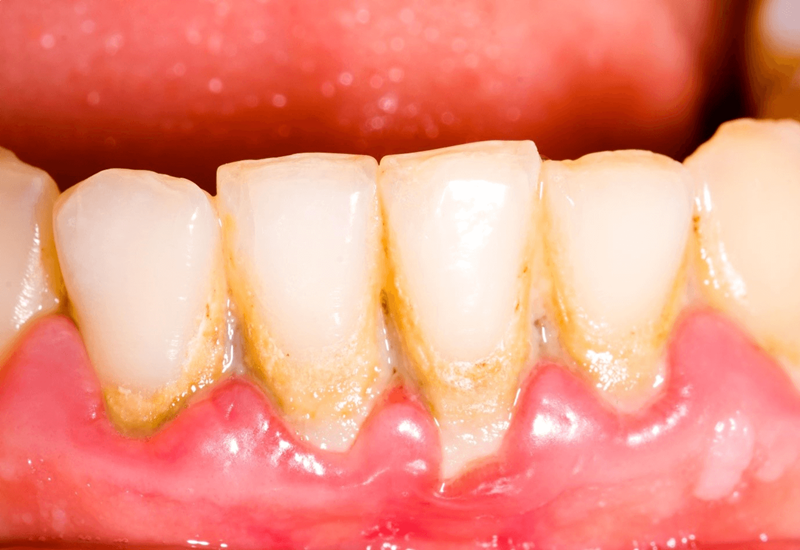 Cao răng gây ra nhiều bệnh răng miệng