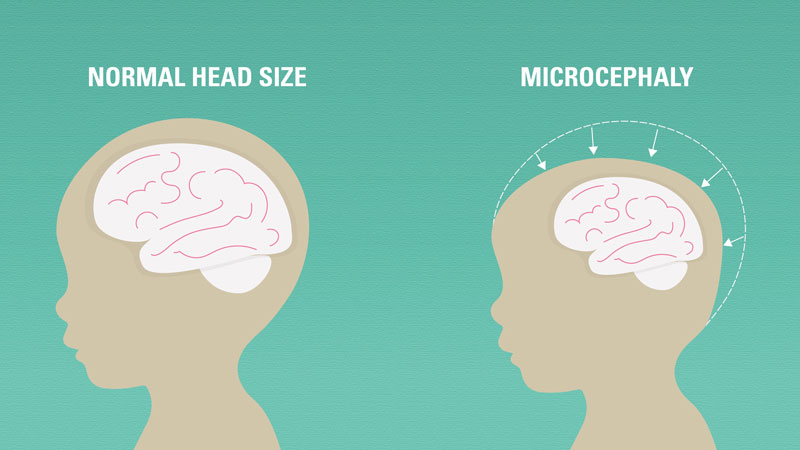 Khi bị dị tật đầu nhỏ, não bộ của trẻ phát triển khá nhỏ