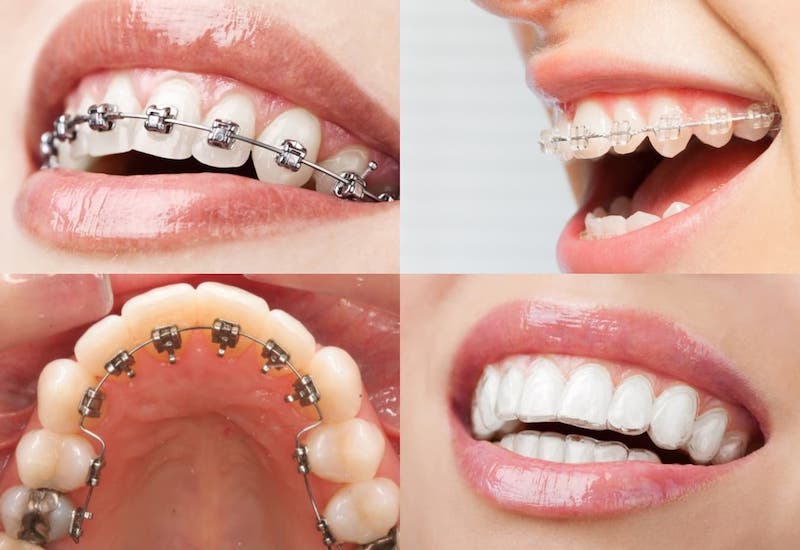 Niềng răng là giải pháp hiệu quả để khắc phục tình trạng răng bị hô, móm hay xô lệch,...