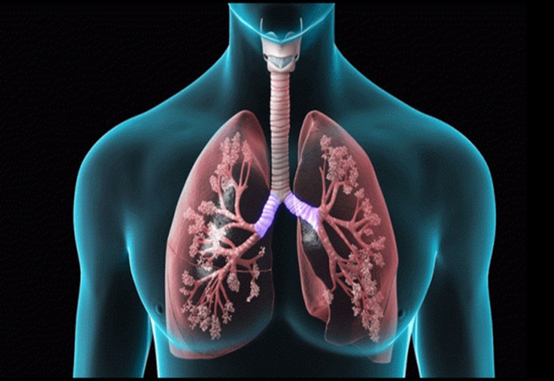 Xơ phổi là căn bệnh nguy hiểm