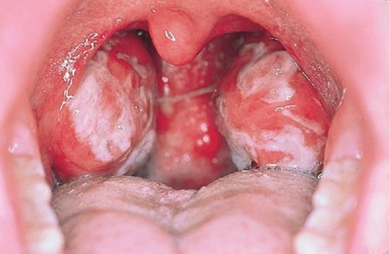 Bệnh nhân mắc bệnh bạch cầu rất dễ bị nhiễm trùng đường hô hấp