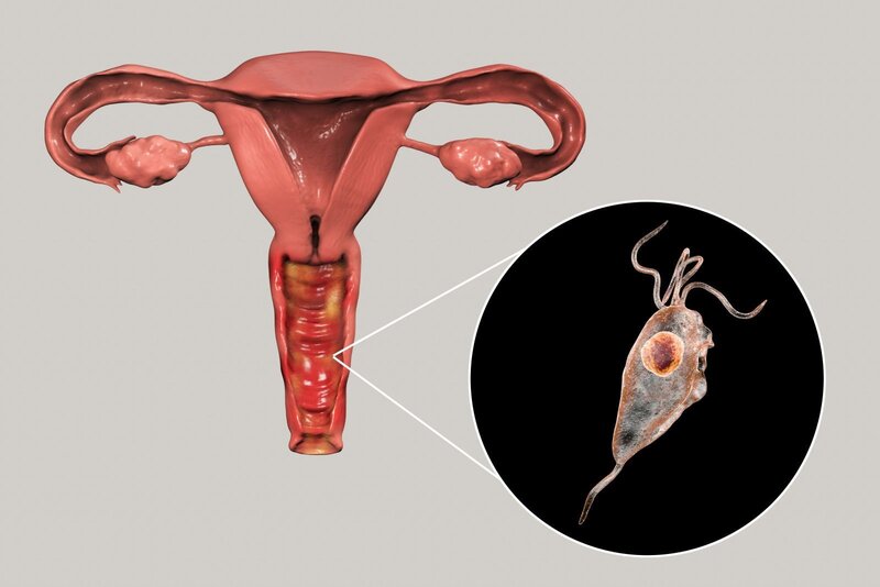 Trichomonas Vaginalis xâm nhập có thể gây viêm âm đạo, niệu đạo