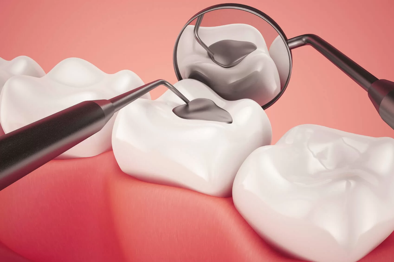 Có thể trám lỗ trên ngà răng nếu đây là nguyên nhân gây răng nhạy cảm