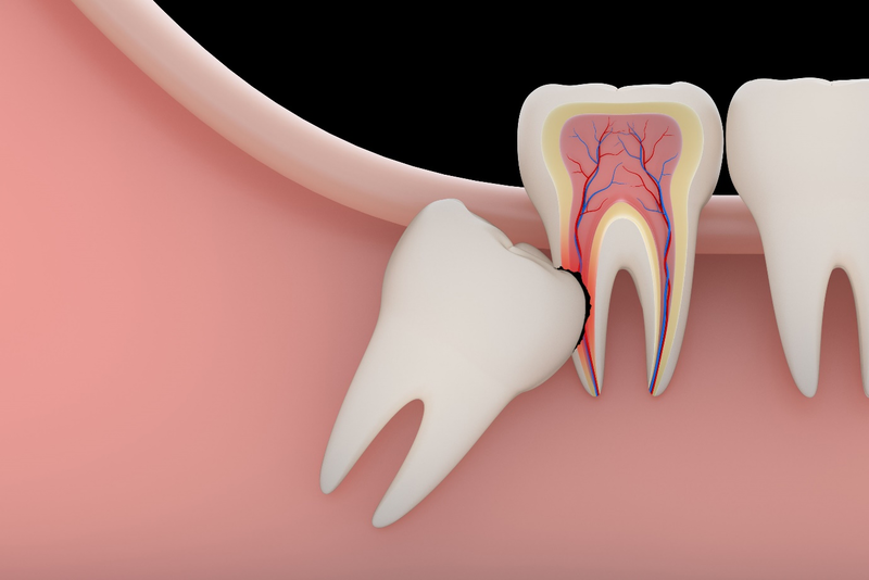 Răng khôn mọc có thể gây tổn thương răng bên cạnh
