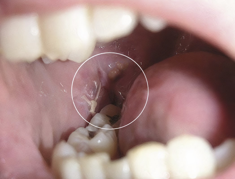 Răng khôn mọc rất dễ gây sâu răng, lệch hàm răng