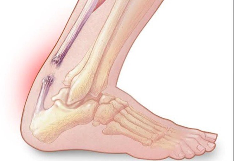Viêm điểm bám gân gót chân do nhiều nguyên nhân gây ra