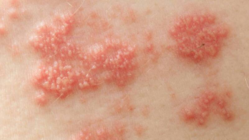 HPV là gì có nguy hiểm không? Tìm hiểu toàn diện về nguy cơ và cách phòng ngừa